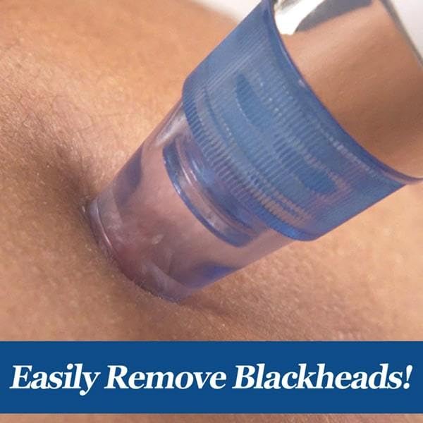 ULTRA POWERFUL BLACKHEADS & WHITEHEADS REMOVER