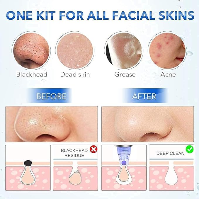 ULTRA POWERFUL BLACKHEADS & WHITEHEADS REMOVER